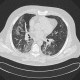 Wegener's granulomatosis, sequelae of alveolar hemorrhage: CT - Computed tomography